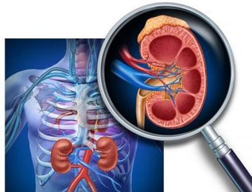 bệnh viêm cầu thận
